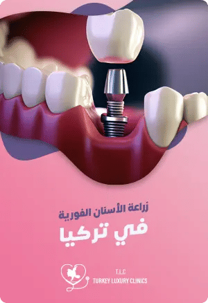 زراعة الأسنان الفورية في تركياfeatured image
