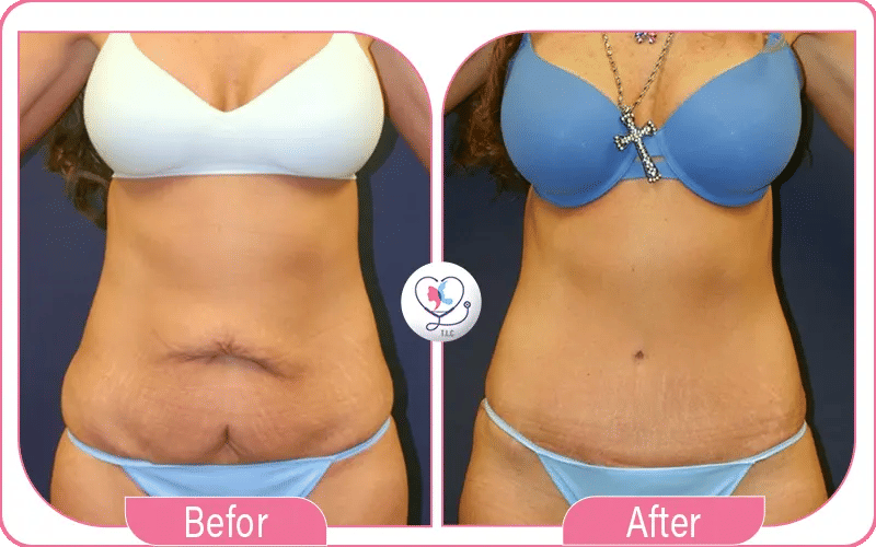 Tummy tuck in Turkey Before and After Photos