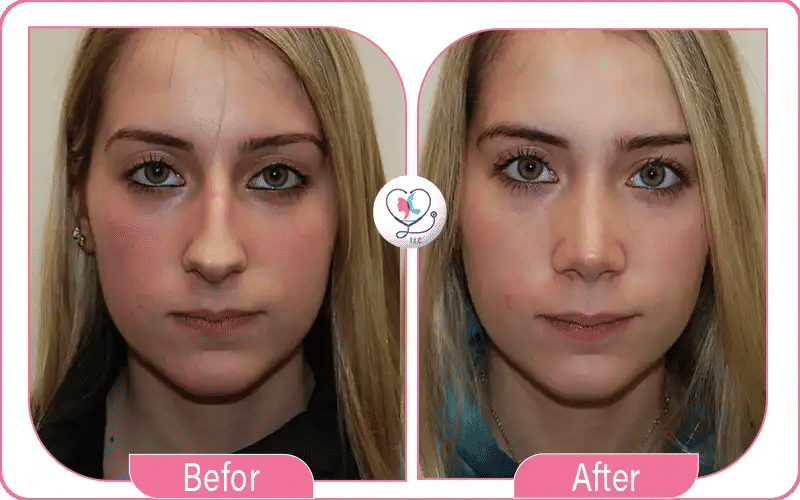 متى تنزل ارنبة الأنف بعد العملية؟