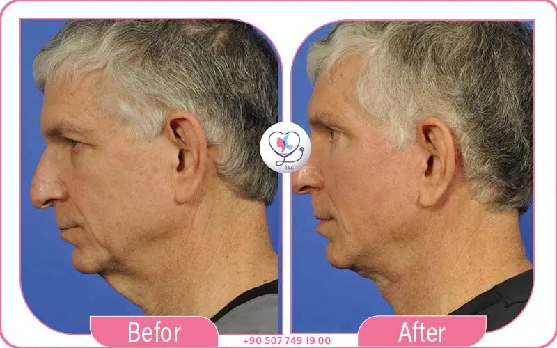 تكلفة شد الوجه في تركيا لاكشري كلينك