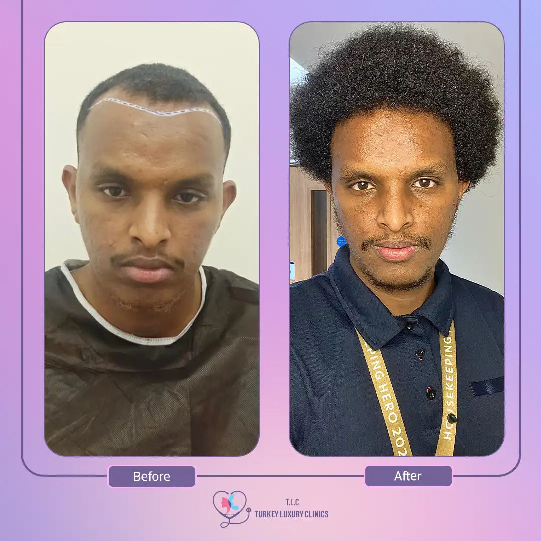 تقنية البيركوتان لزراعة الشعر في تركيا لاكشري كلينك