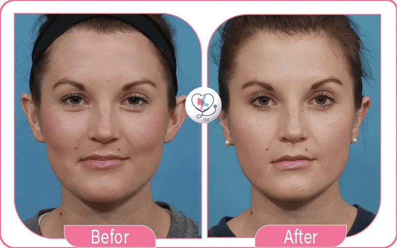 Otoplasty Results