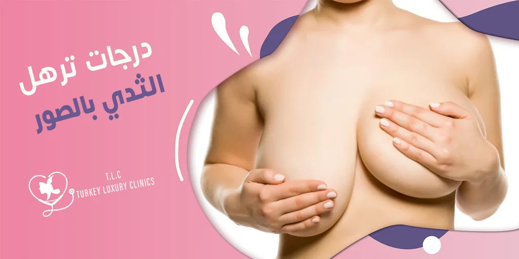 درجات ترهل الثدي بالصور: صور حقيقية مع العلاج المناسب