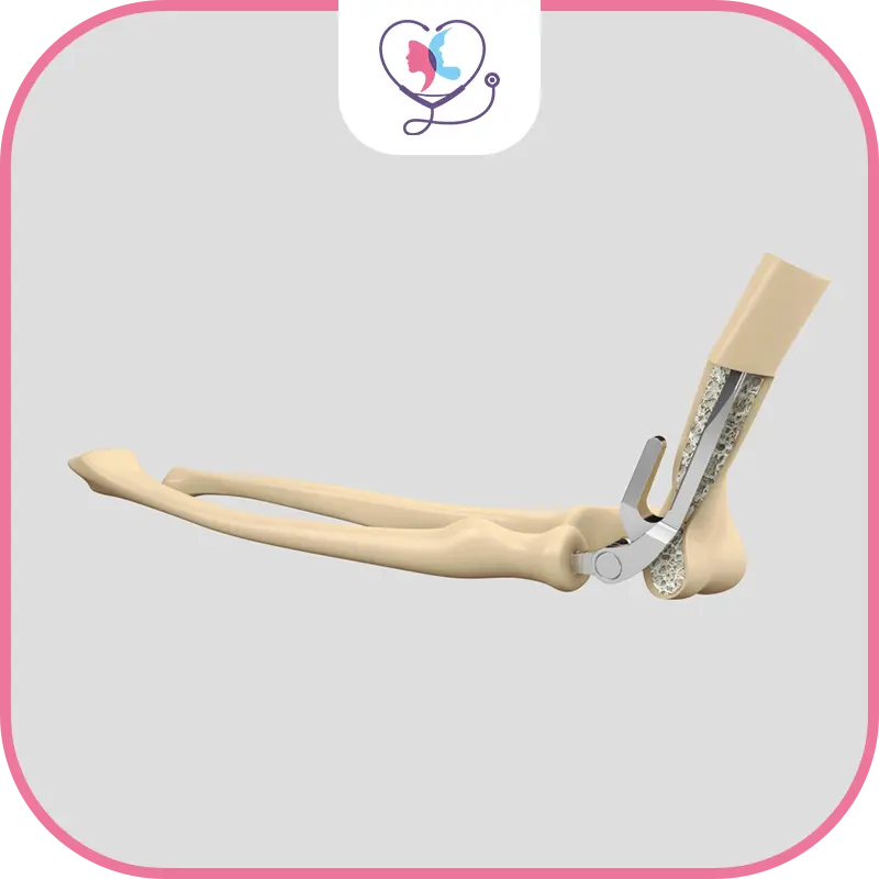 تكلفة استبدال مفصل المرفق في تركيا