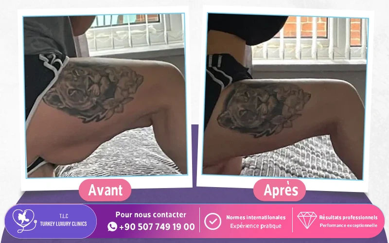 lifting des cuisses avant apres
