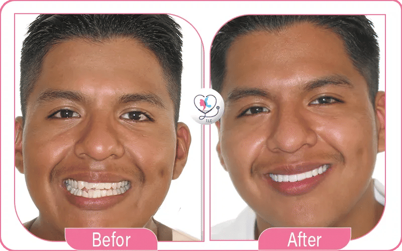 تجربتي مع تقويم الأسنان الشفاف