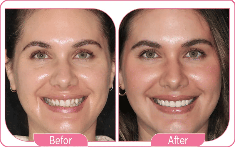 Using Dental Implants and Veneers for Missing Teeth