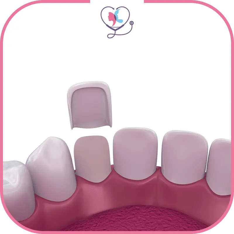 ماهي أسعار قشور الأسنان في مختلف الدول؟