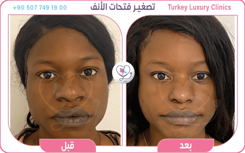 تصغير فتحات الأنف