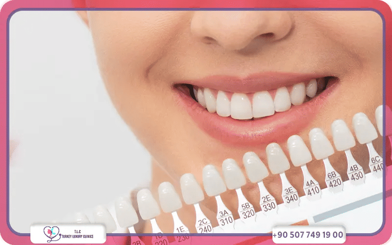 تجميل الأسنان الأمامية بدون تقويم