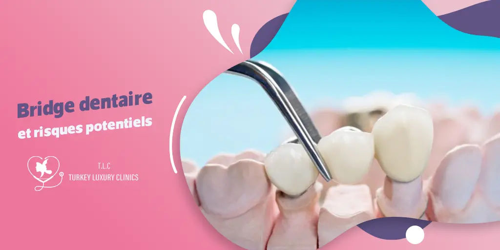 Bridge dentaire et risques potentiels pour les dents adjacentes