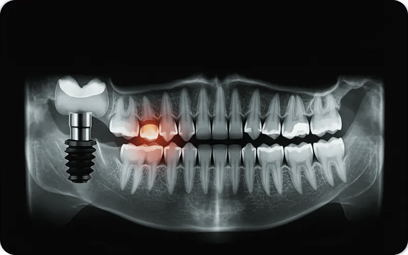What Happens if a Bad Dental Implant is Not Fixed?