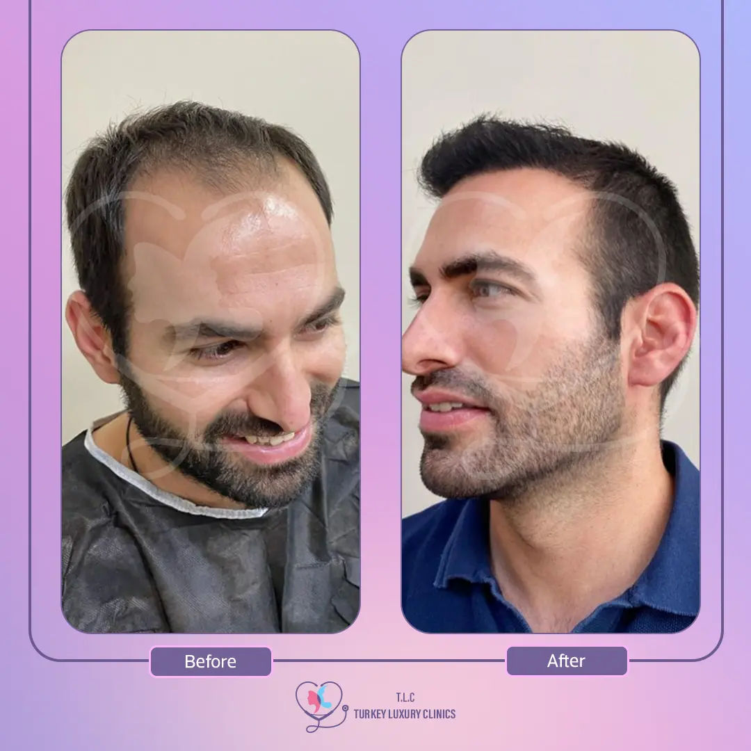 زراعة الشعر للرجال في تركيا: التقنيات والنتائج مع التكلفة
