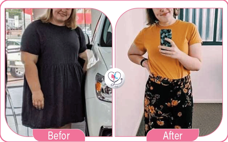 عملية تحويل المسار المصغر بعد التكميم-1772049183638