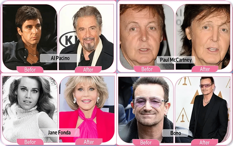 Celebrity Lower Blepharoplasty Before and After