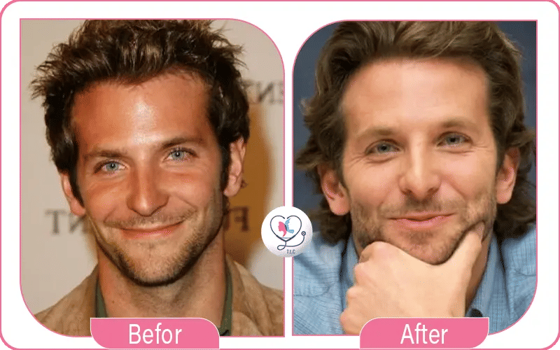 Bradley Cooper et la chirurgie des yeux