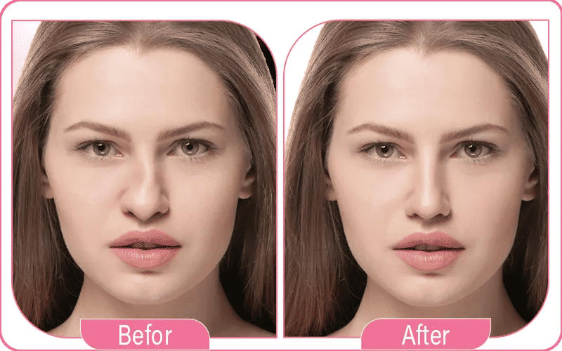 علاج تشوهات الأنف في تركيا لاكشري كلينك