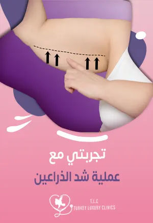 تجربتي مع عملية شد الذراعينfeatured image