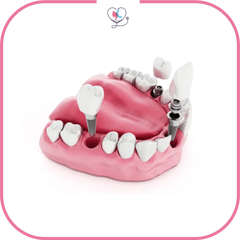 qu’est-ce-qu’un-implant-dentaire-et-pour-quel-objectif-?