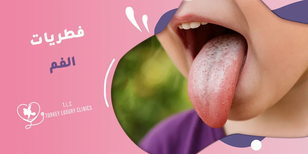فطريات الفم: الأسباب، الأعراض وطرق فعالة لعلاجها بسرعة