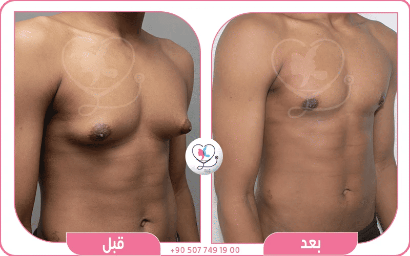 التعافي بعد عملية الجاينو