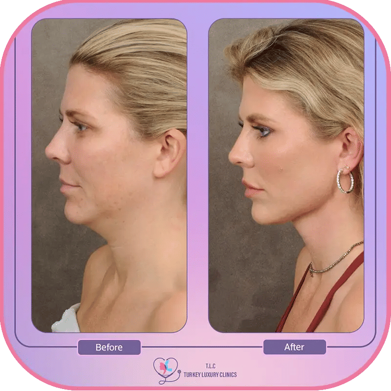 قرار إجراء عملية شد الرقبة