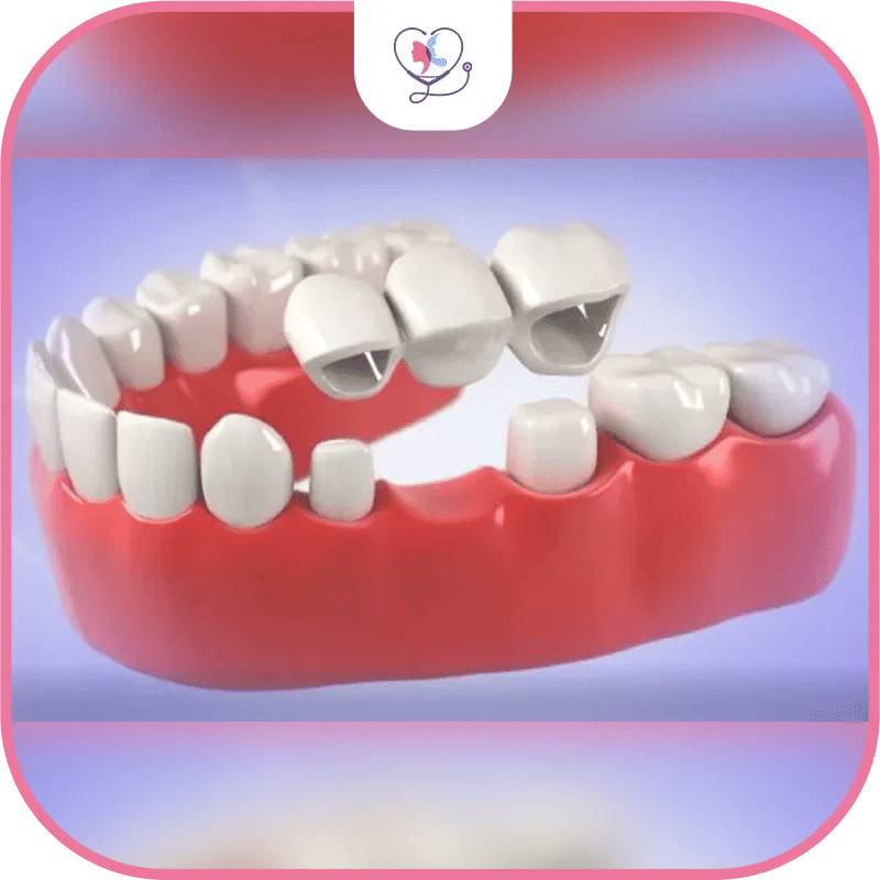 Prix d'un bridge dentaire en Turquie : Coûts, matériaux et devis [Mise à jour 2025]