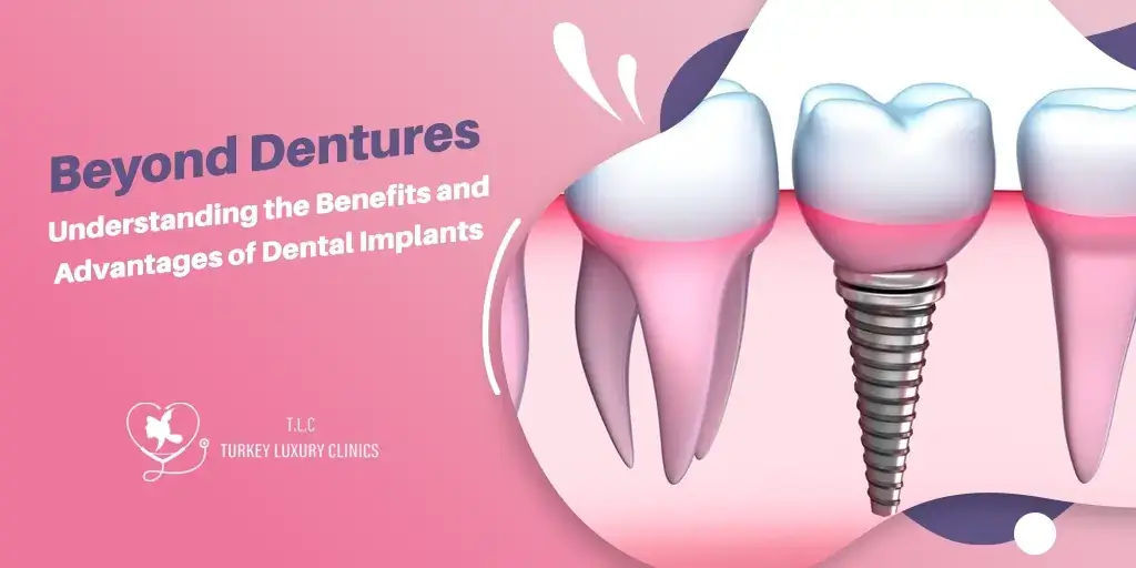 Oltre le Protesi: I Vantaggi degli Impianti Dentali
