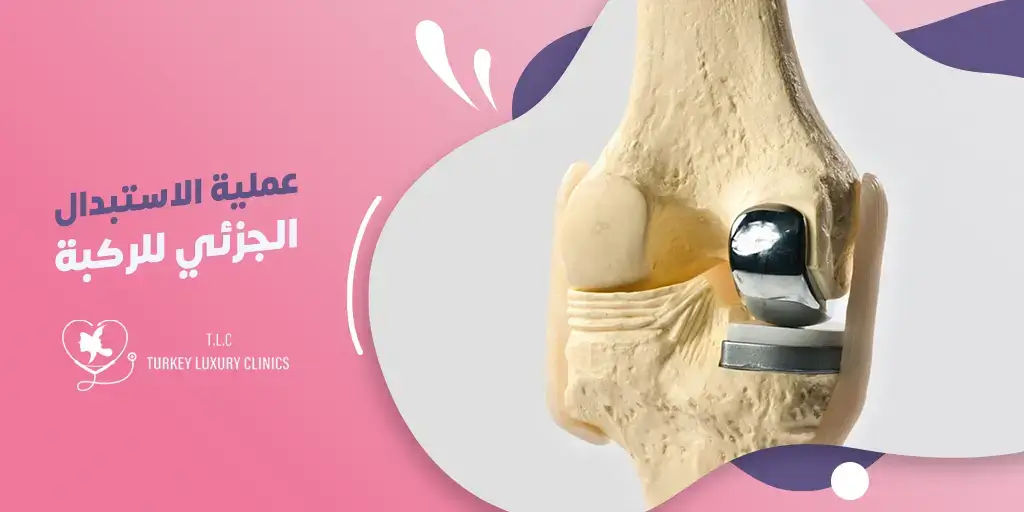 ماهي عملية الاستبدال الجزئي للركبة في تركيا؟