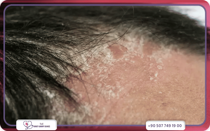 ما هي مضاعفات صدفية الرأس؟