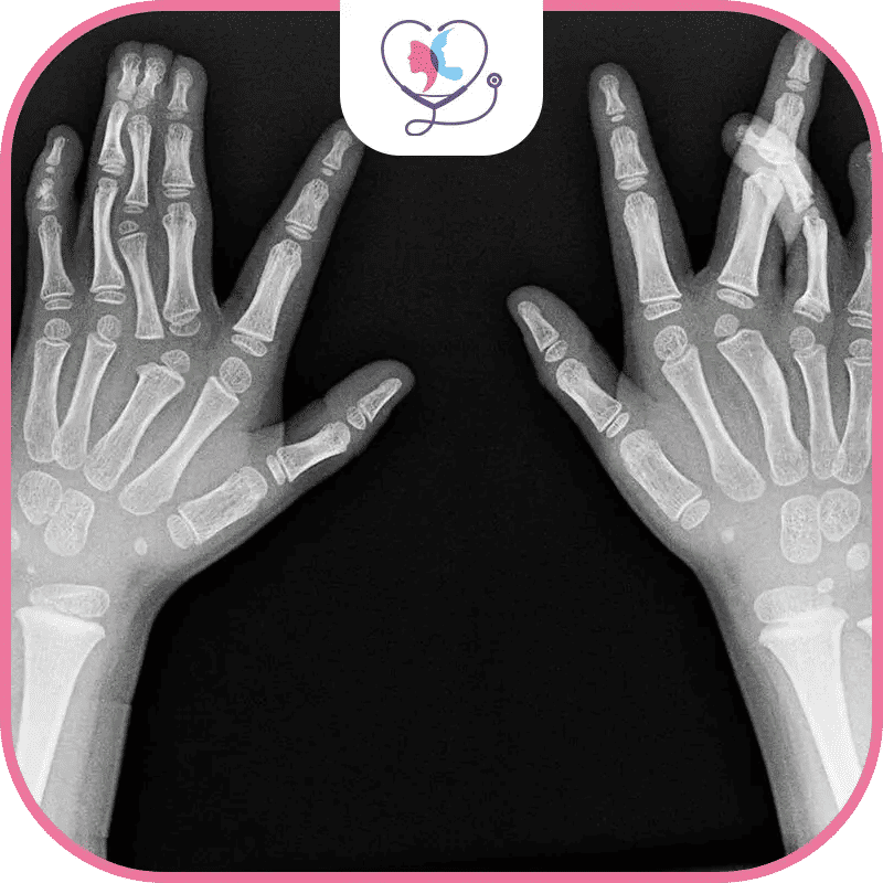 جراحة عظام الأطفال في تركيا