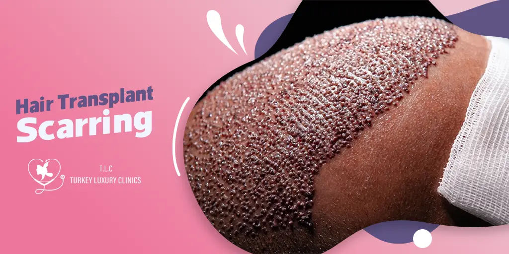 Hair Transplant Scarring