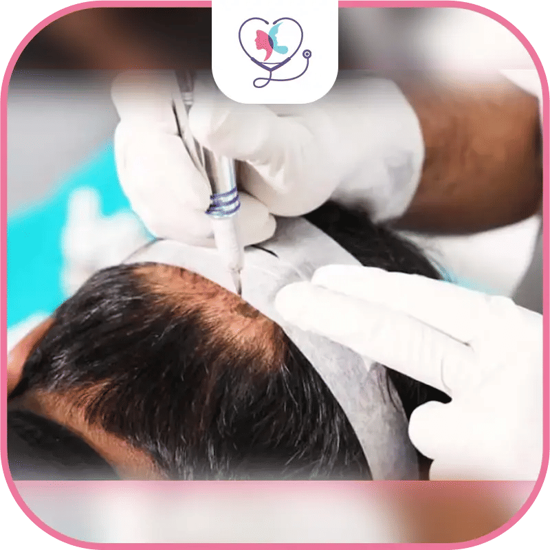 The Safety of Hair Transplants