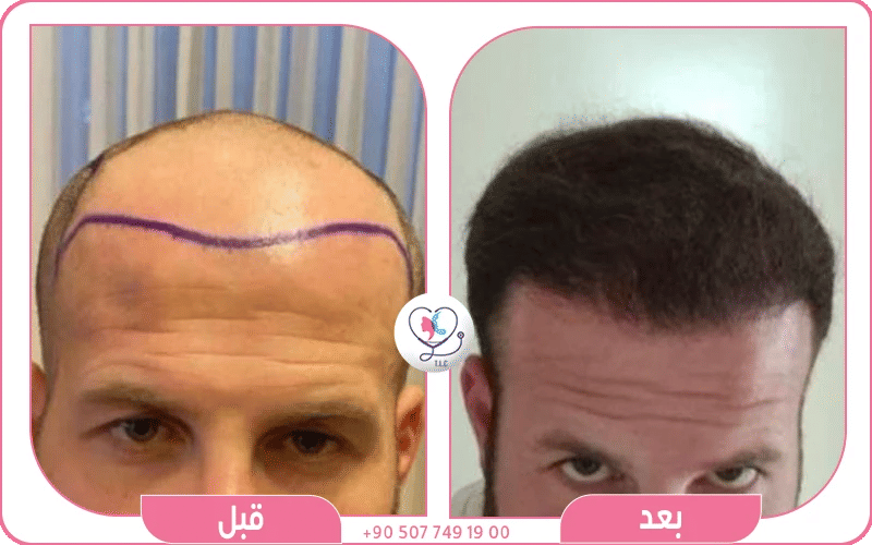 عمليات زراعة الشعر في تركيا