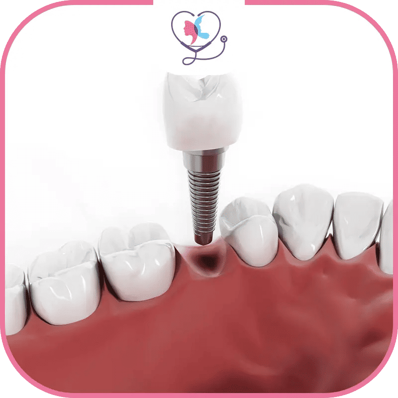 Convalescence après un implant dentaire