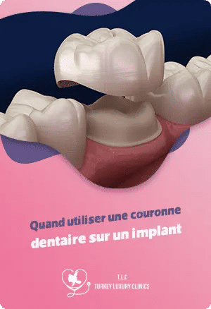 Quand utiliser une couronne dentaire sur un implant ?featured image