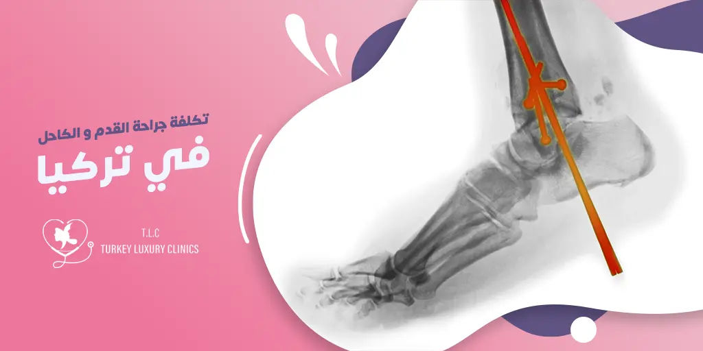 تكلفة جراحة القدم والكاحل في تركيا