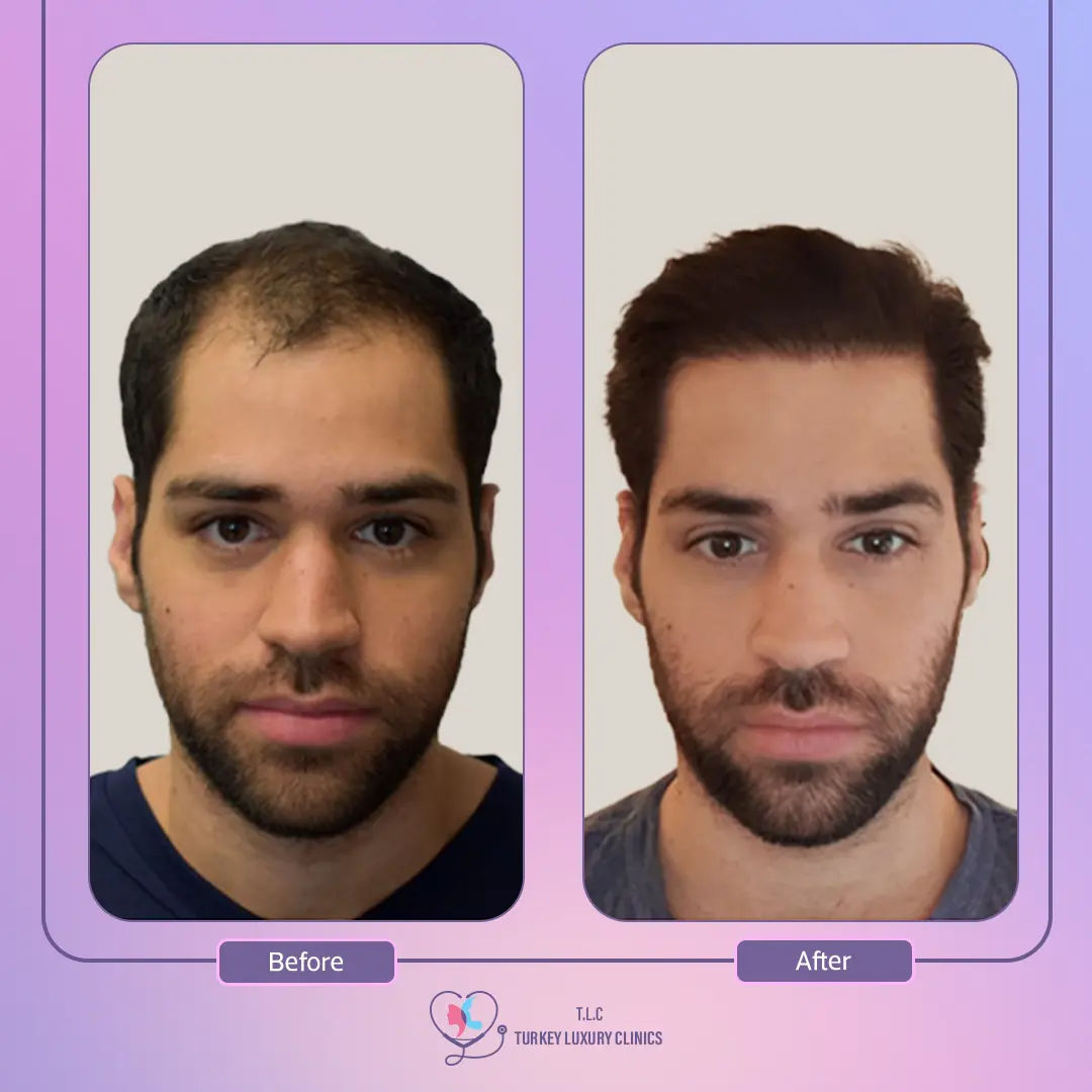 ماهي تقنيات زراعة الشعر في تركيا؟