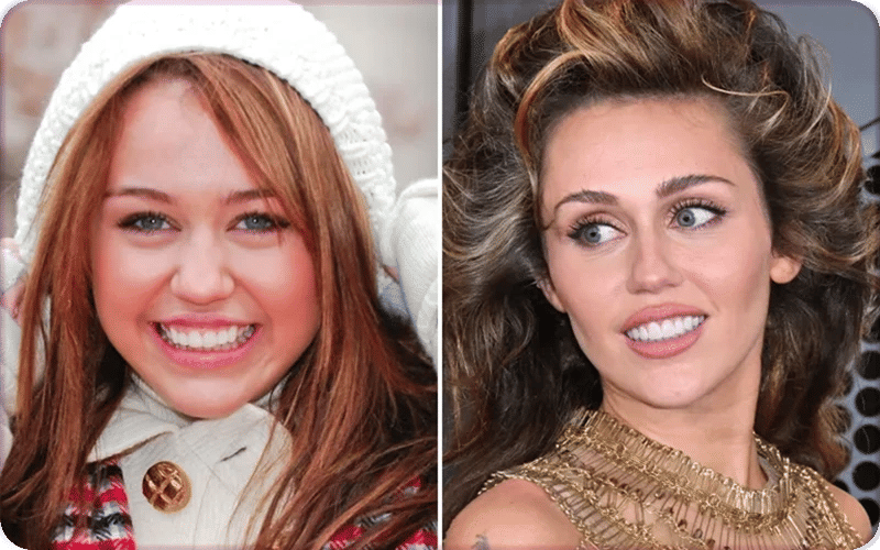 Miley Cyrus showing her teeth before and after veneers, highlighting the smile transformation.