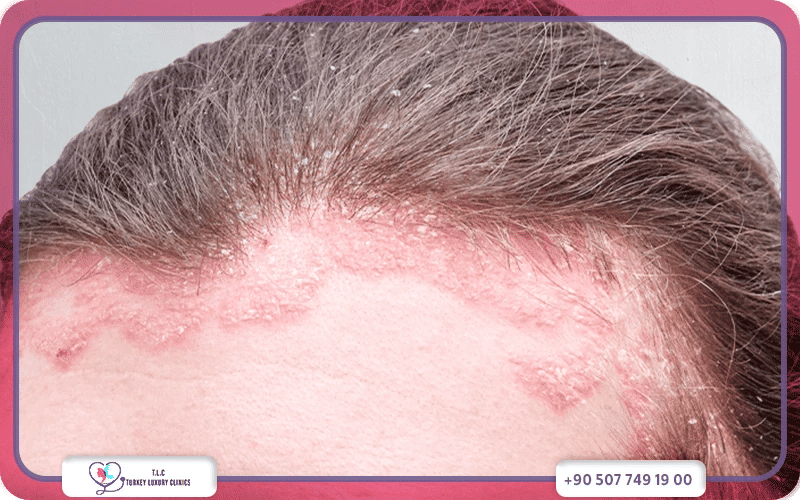 ما هي أعراض صدفية الرأس؟