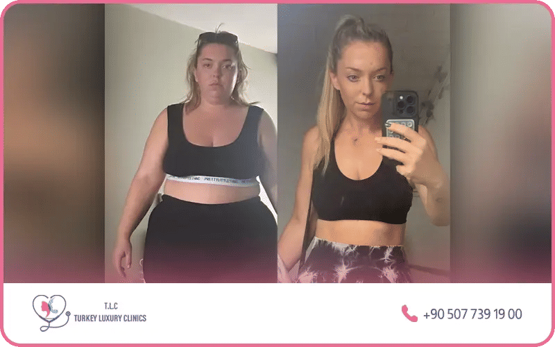 Changement après ballon gastrique avant / après