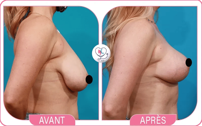 Lifting mammaire sans prothèse Avant/Après