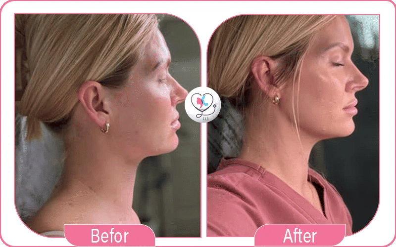 Nefertiti Neck Lift Before & After Photos: What to Expect image 1772044334289