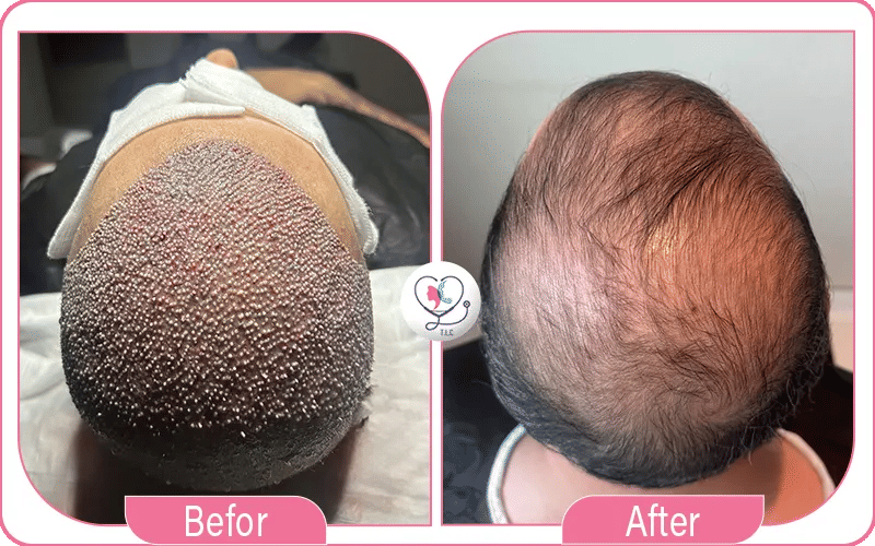 Sapphire FUE Before and After Photos