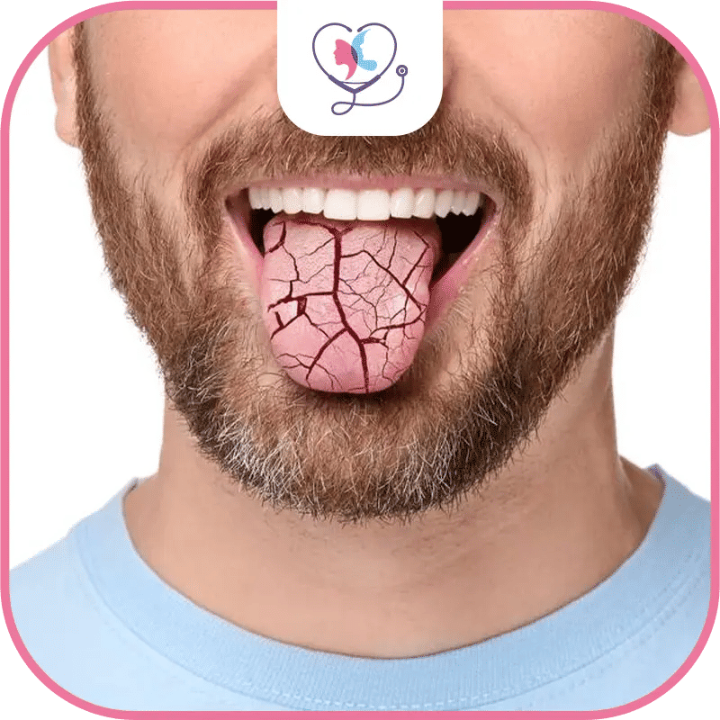 xérostomie - bouche sèche - secheresse buccale