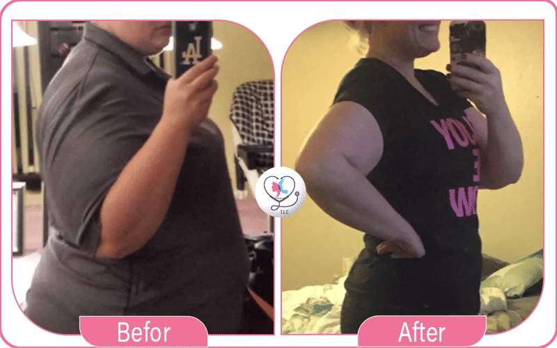 Sleeve avant / après 1 mois