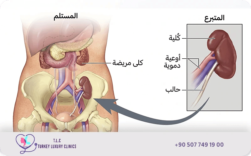 ما هي زراعة كلى؟