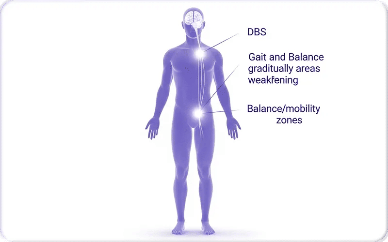 Why Deep Brain Stimulation Effectiveness May Decrease Over Time?