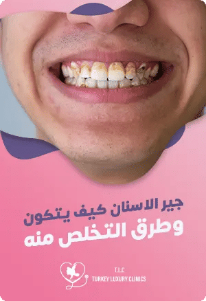 جير الاسنان: كيف يتكون؟ وطرق التخلص منه للحفاظ على صحة أسنانكfeatured image
