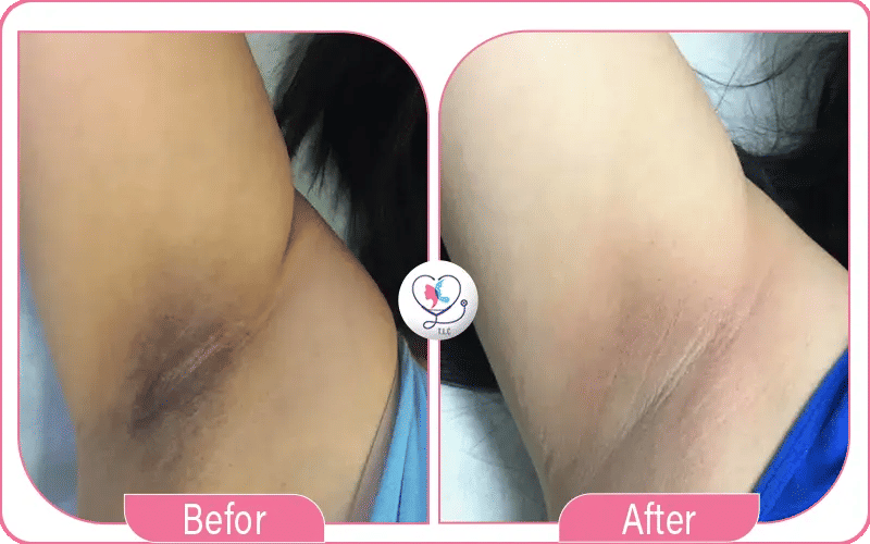 تفتيح المناطق الحساسة بالليزر قبل وبعد